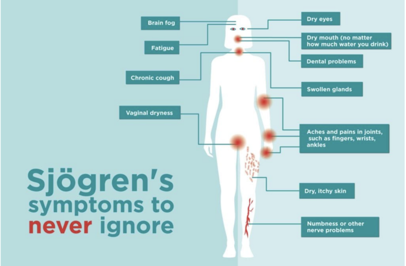 sjrogren's symptoms